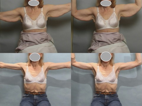 arm lift before and after