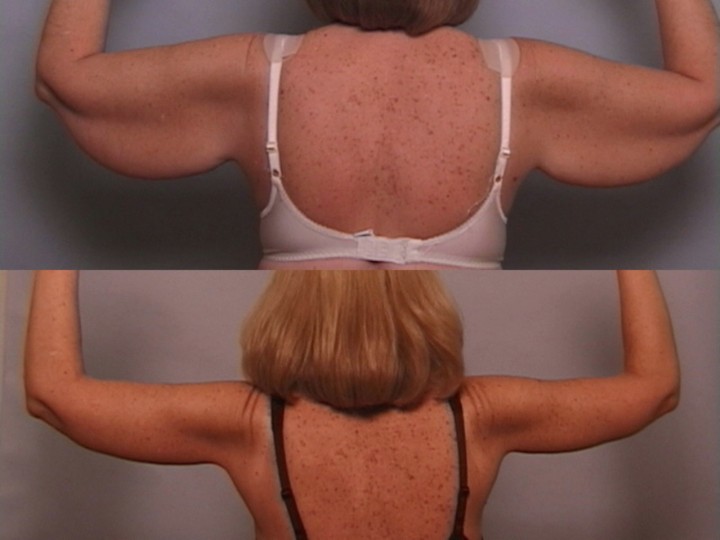 arm lift before and after