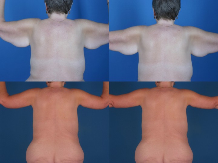 arm lift before and after