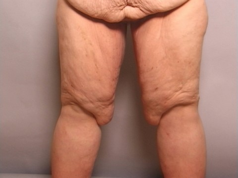 thigh lift patient