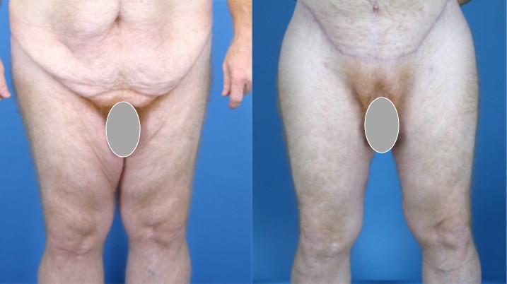 thigh lift before and after