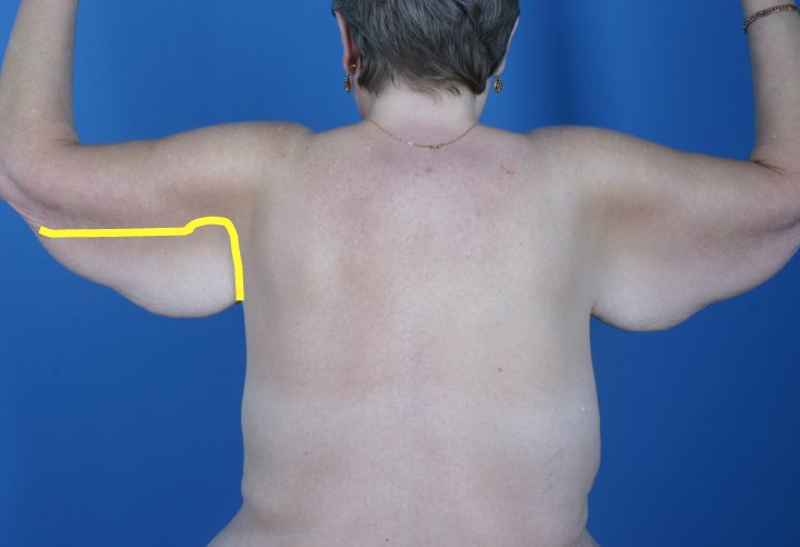 arm lift example