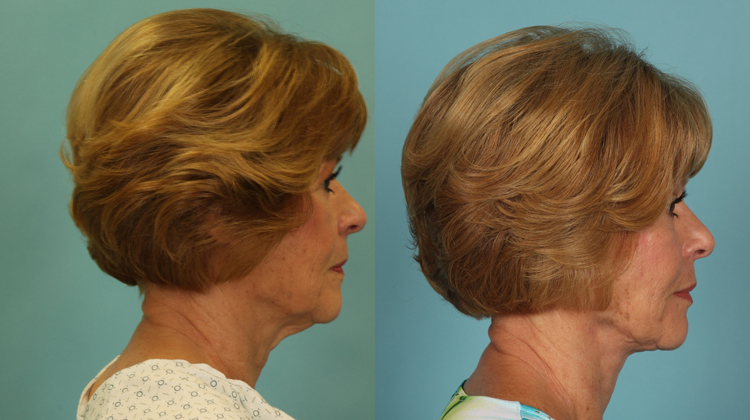 neck lift before and after