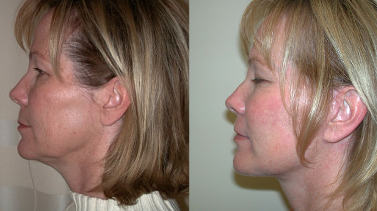 neck lift before and after