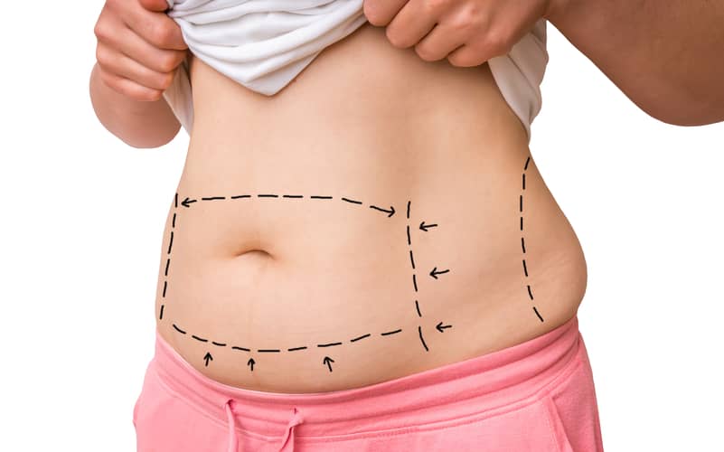 Tummy Tuck Austin