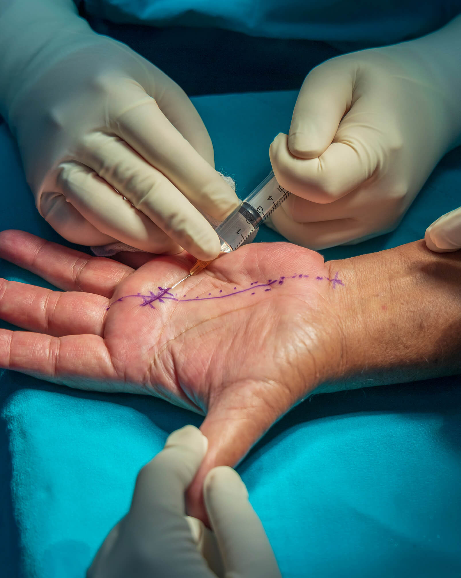 Microsurgical Reconstruction Surgery