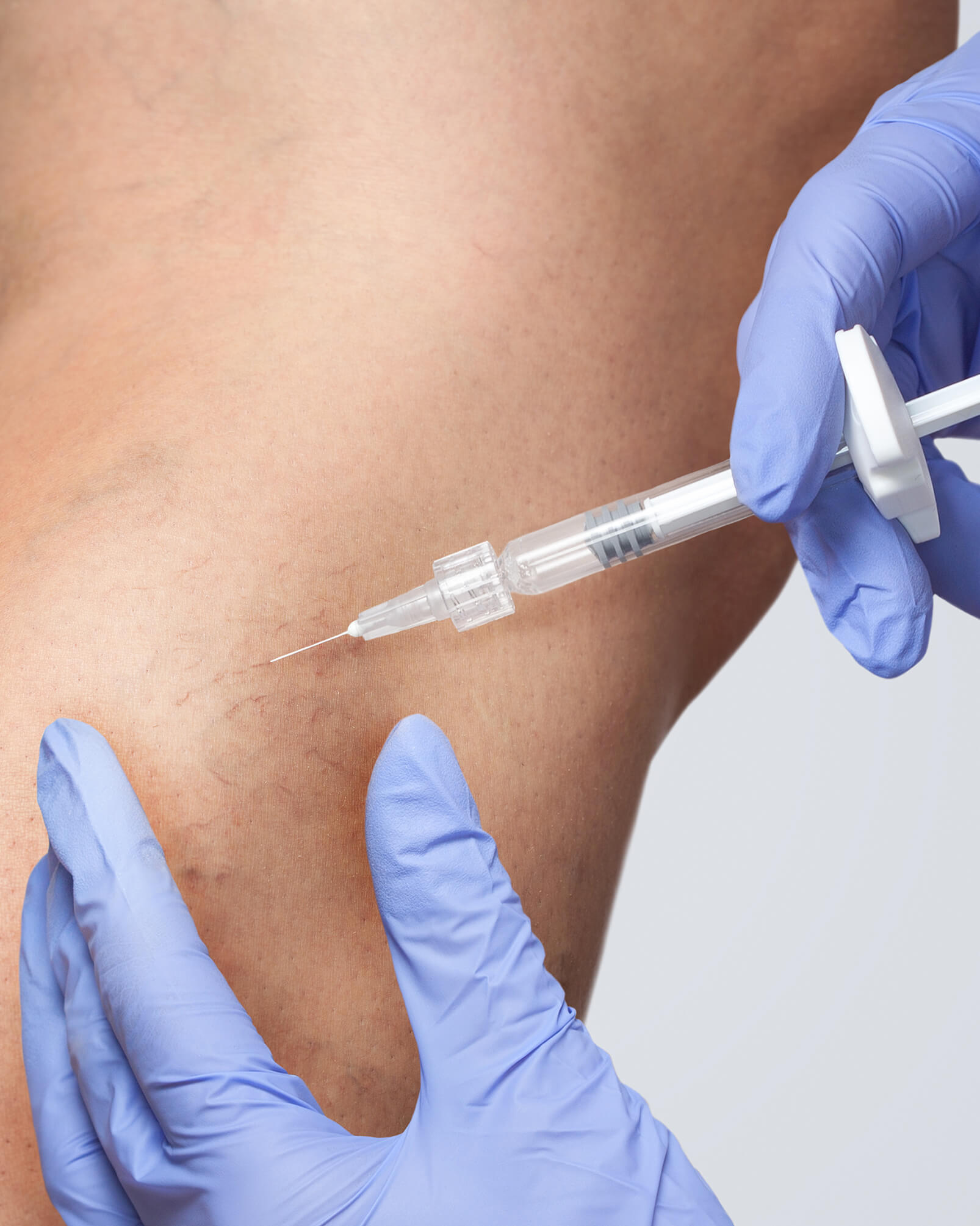 spider veins injection