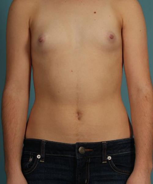 Case--2723 | Before Breast Augmentation