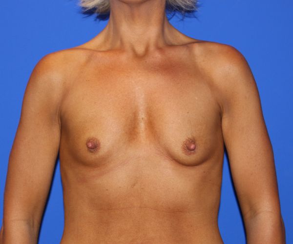 Case--2735 | Before Breast Augmentation