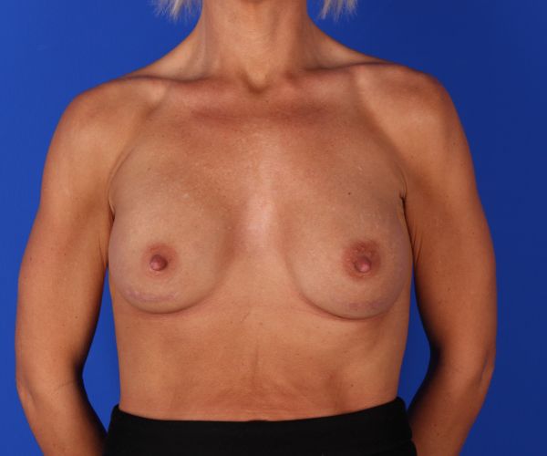 Case--2735 | After Breast Augmentation