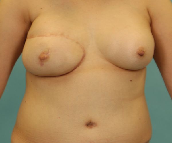 Breast-Reconstruction-Case--3451 | After Breast Reconstruction