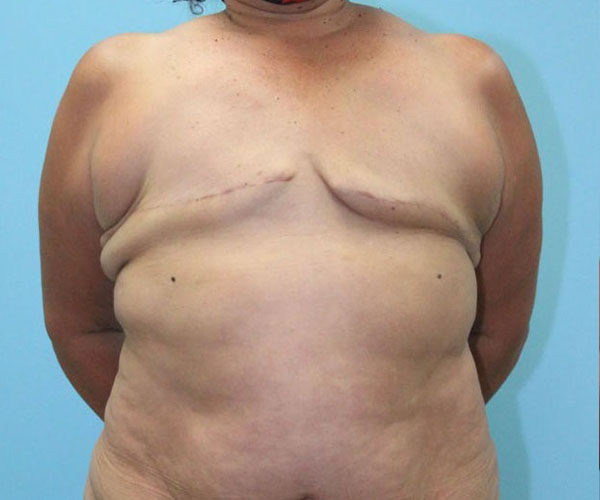 Breast-Reconstruction-Case--4528 | Before Breast Reconstruction
