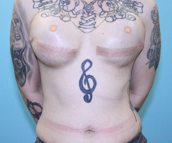 Breast-Reconstruction-Case--5000 | After Breast Reconstruction