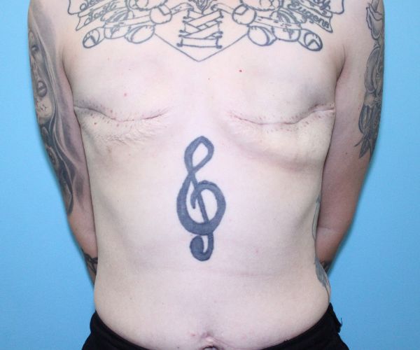 Breast-Reconstruction-Case--5000 | Before Breast Reconstruction