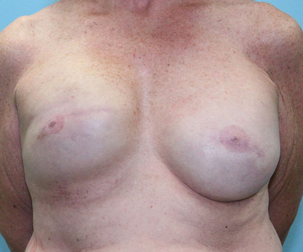 Breast-Reconstruction-Case--5049 | Before Breast Reconstruction