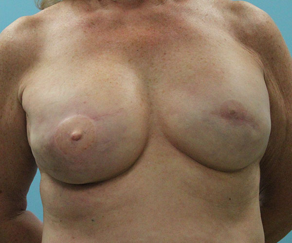 Breast-Reconstruction-Case--5049 | After Breast Reconstruction