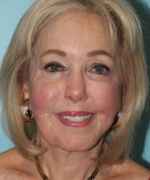 Case--5065 | After Brow Lift