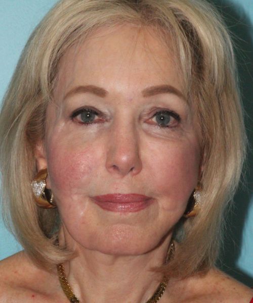 Case--5065 | Before Brow Lift