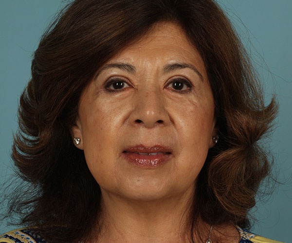 Case--1884 | After Eyelid Lift