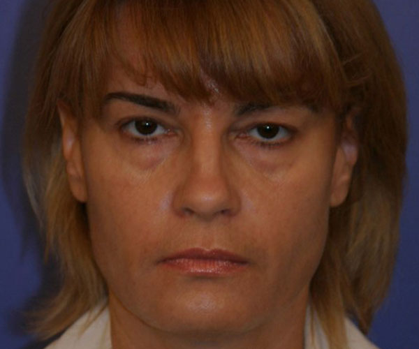 Case--1930 | Before Eyelid Lift