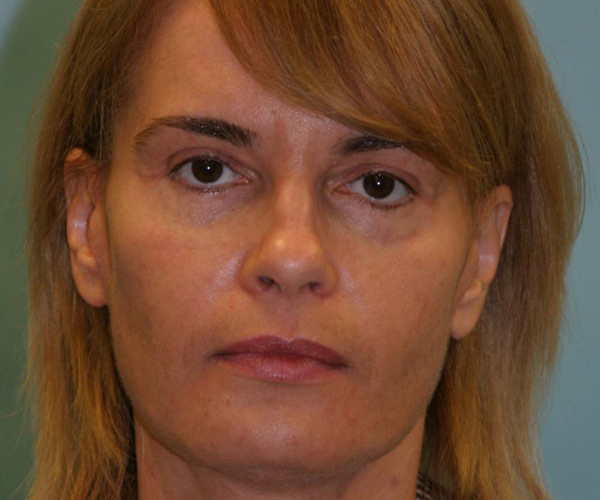 Case--1930 | After Eyelid Lift