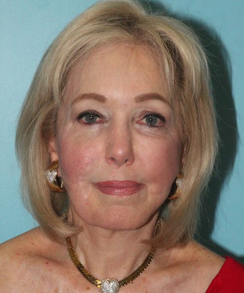 Case--2784 | Before Facelift | Neck Lift