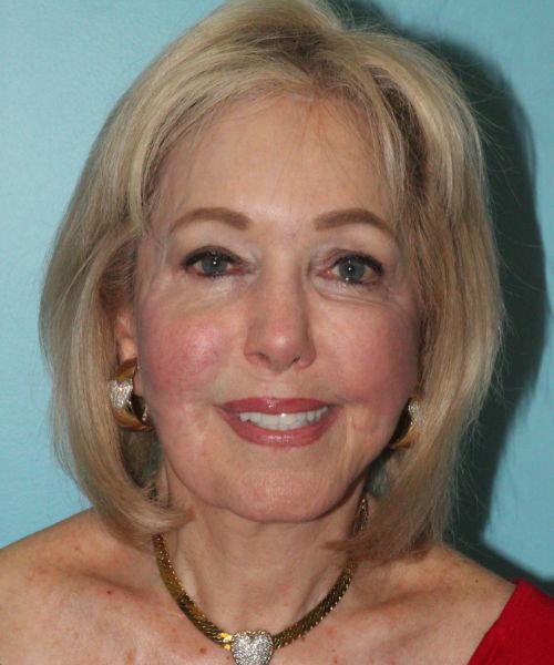 Case--2784 | After Facelift | Neck Lift