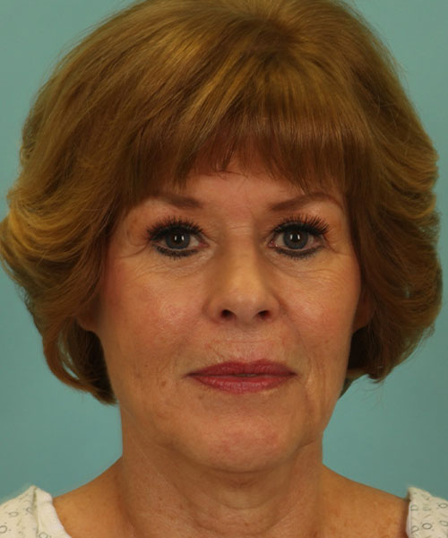 Case--1248 | Before Facelift | Neck Lift