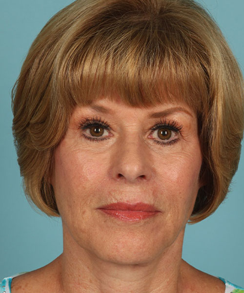 Case--1248 | After Facelift | Neck Lift