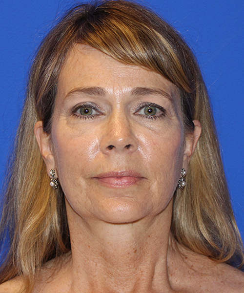 Case--1911 | After Facelift | Neck Lift