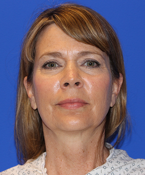 Case--1911 | Before Facelift | Neck Lift