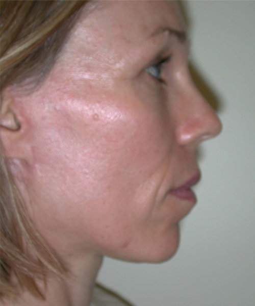 Case--1906 | After Facelift | Neck Lift