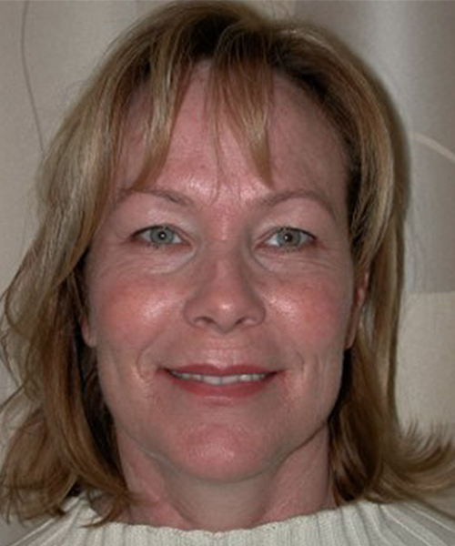 Case--1923 | Before Facelift | Neck Lift