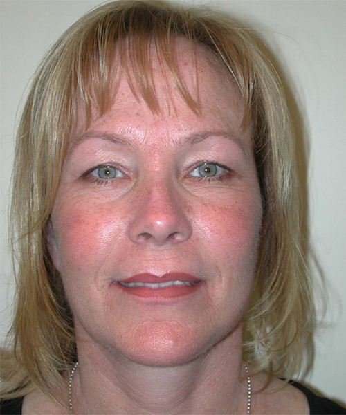 Case--1923 | After Facelift | Neck Lift