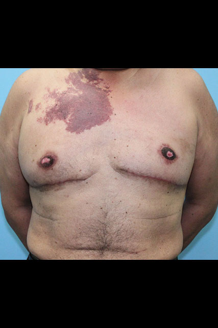 Gynecomastia-Case--5784 | After Gynecomastia