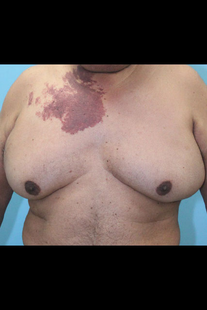 Gynecomastia-Case--5784 | Before Gynecomastia