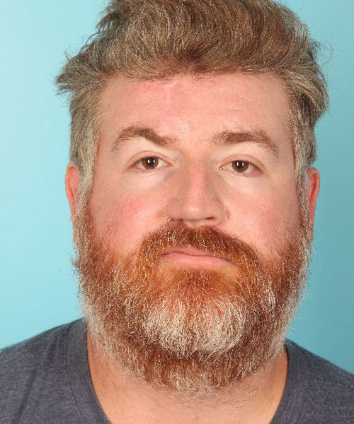 Case--3273 | After Nasal Reconstruction