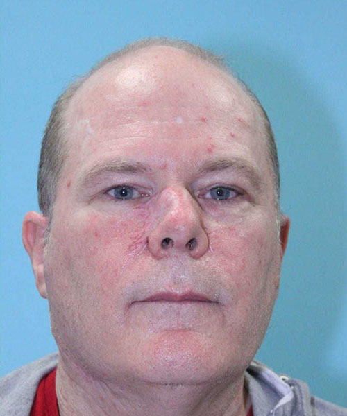 Case--4385 | After Nasal Reconstruction