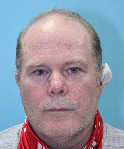 Case--4385 | Before Nasal Reconstruction