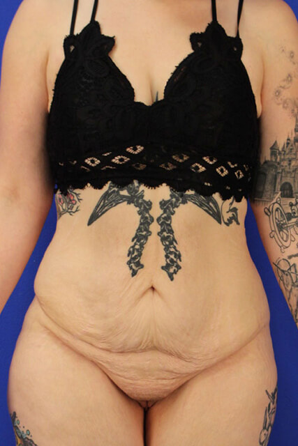 Tummy-Tuck-Case--4880 | Before Tummy Tuck