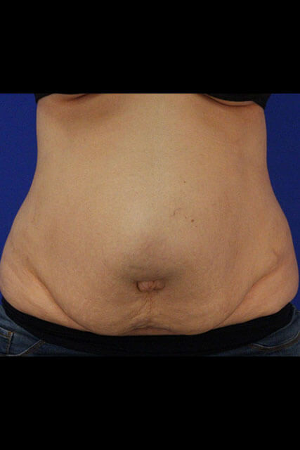 Case--1488 | Before Tummy Tuck 1