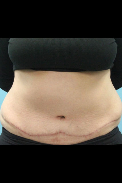 Case--1488 | After Tummy Tuck 1