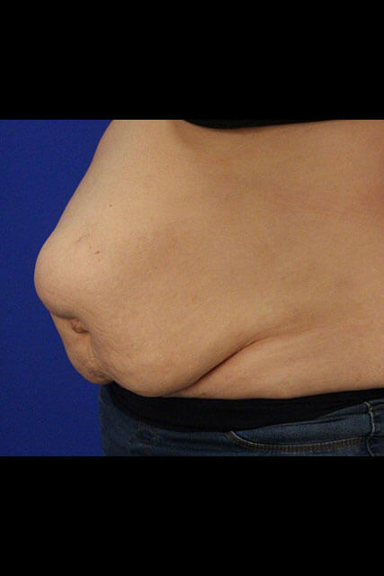 Case--1488 | Before Tummy Tuck 4