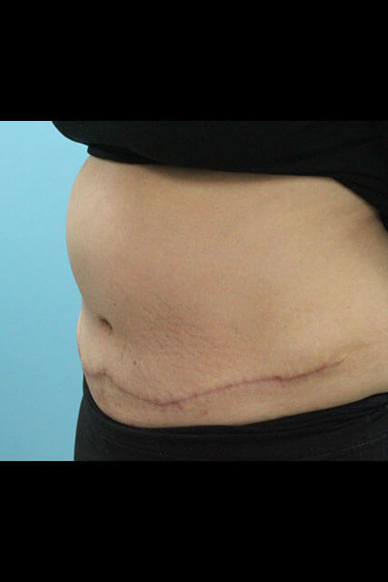 Case--1488 | After Tummy Tuck 4