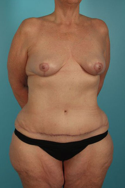 Tummy-Tuck-Case--3291 | After Tummy Tuck