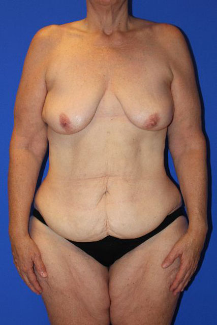 Tummy-Tuck-Case--3291 | Before Tummy Tuck