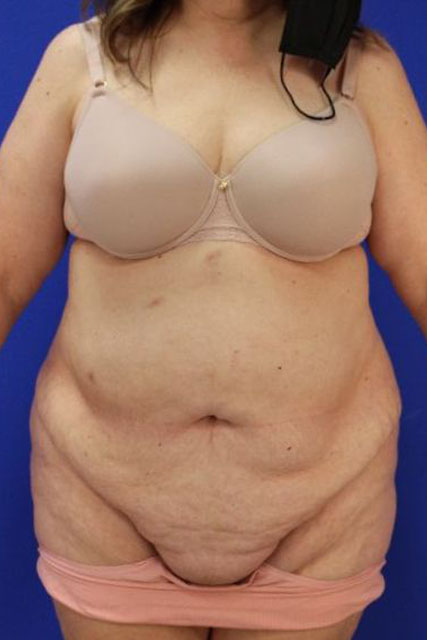 Tummy-Tuck-Case--3280 | Before Tummy Tuck