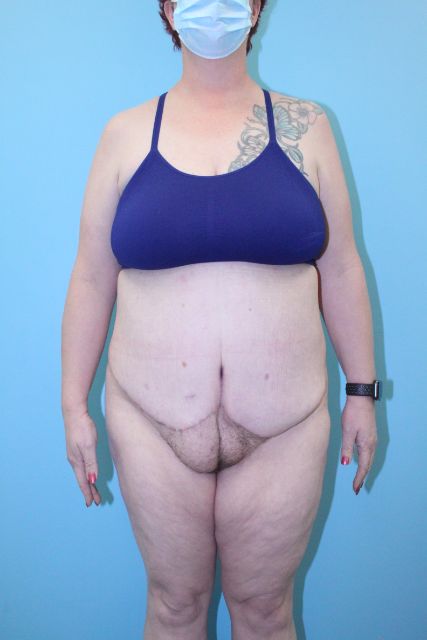 Tummy-Tuck-Case--5014 | After Tummy Tuck