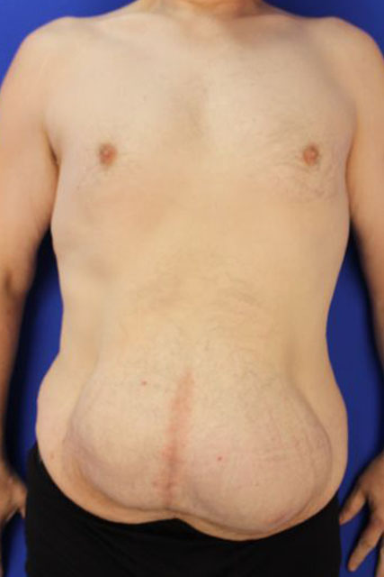 Tummy-Tuck-Case--5032 | Before Tummy Tuck